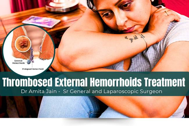Best Treatment for Thrombosed External Hemorrhoids in Delhi by Dr Amita Jain